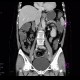Lung carcinoma, accidental finding on enterography: CT - Computed tomography